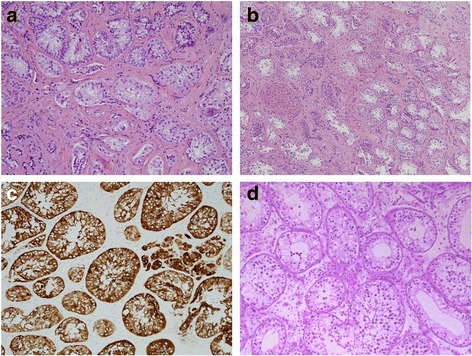 A novel, homozygous mutation in <i>desert hedgehog</i> (<i>DHH</i>) in a 46, XY patient with dysgenetic testes presenting with primary amenorrhoea: a case report.