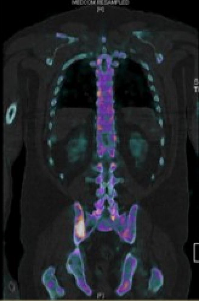 Follicular lymphoma presenting as scalp mass deformity: Case Report and Review of the literature.