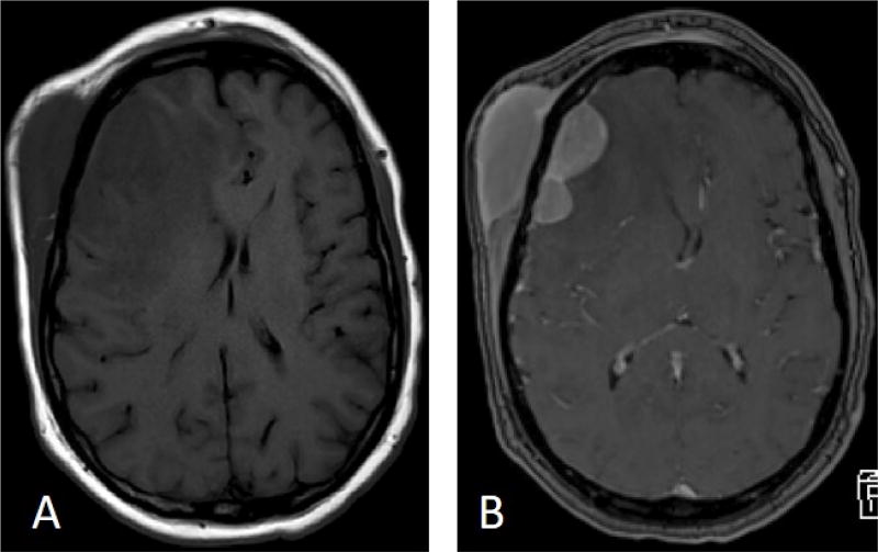 Follicular lymphoma presenting as scalp mass deformity: Case Report and Review of the literature.