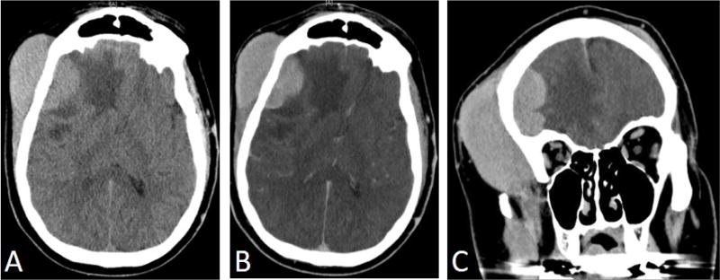 Follicular lymphoma presenting as scalp mass deformity: Case Report and Review of the literature.
