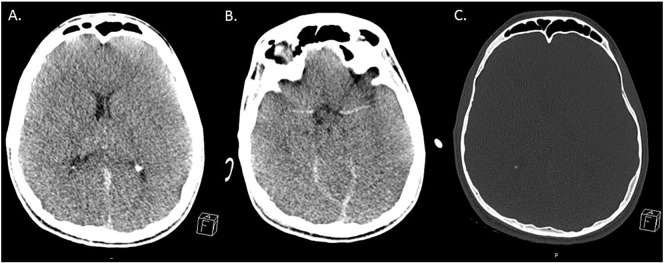 Can the combination of hyperthermia, seizures and ion channel dysfunction cause fatal post-ictal cerebral edema in patients with SCN1A mutations?