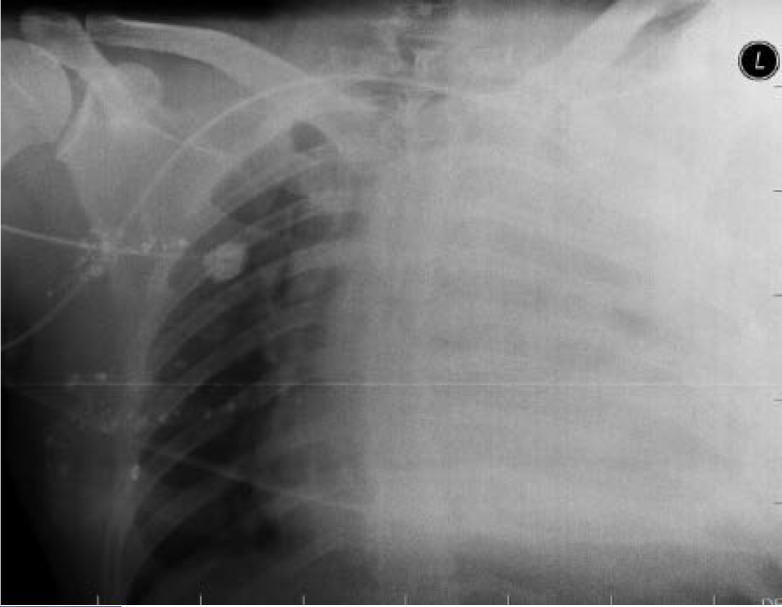 Upper Gastrointestinal Bleeding as Delayed Presentation of Traumatic Diaphragmatic Hernia; a Case Report.