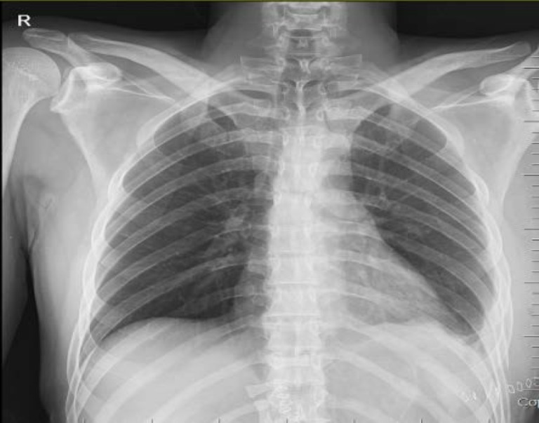 Upper Gastrointestinal Bleeding as Delayed Presentation of Traumatic Diaphragmatic Hernia; a Case Report.