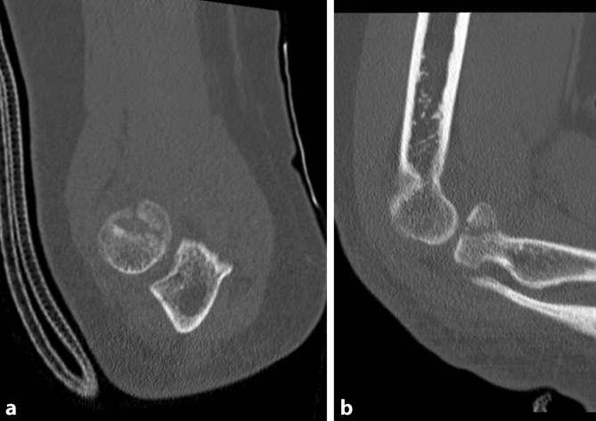 Reasons for surgical revision after conservatively treated radial head fractures-retrospective study of 70 patients.