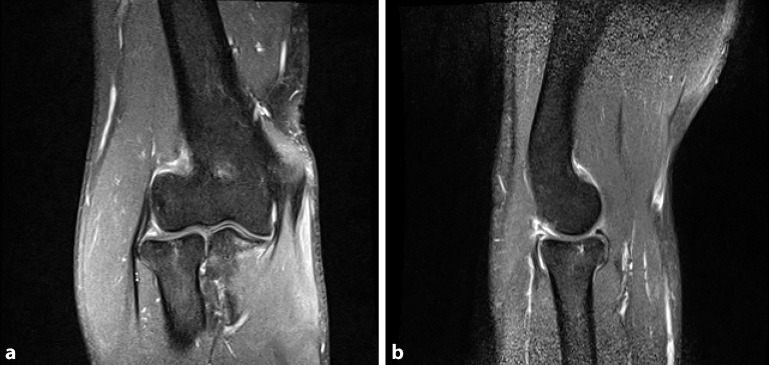Reasons for surgical revision after conservatively treated radial head fractures-retrospective study of 70 patients.