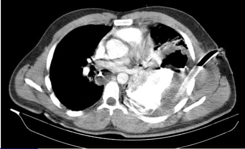 Upper Gastrointestinal Bleeding as Delayed Presentation of Traumatic Diaphragmatic Hernia; a Case Report.