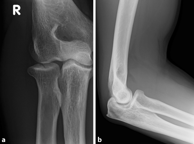 Reasons for surgical revision after conservatively treated radial head fractures-retrospective study of 70 patients.