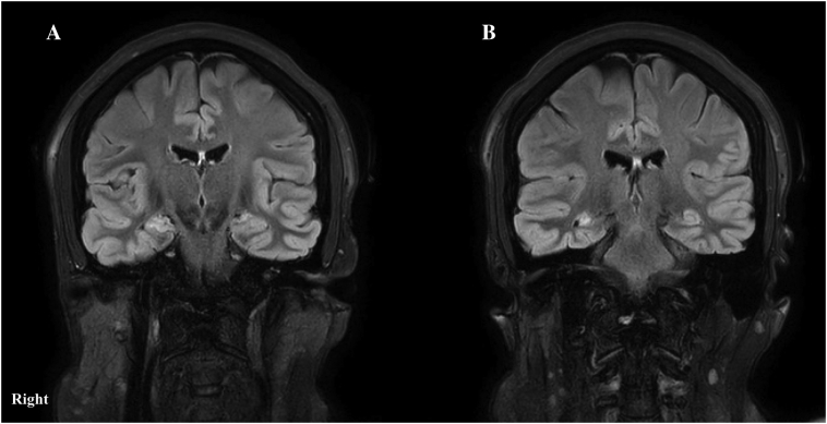 Post-operative nonketotic hyperglycemic induced focal motor status epilepticus related to treatment with corticosteroids following standard anterior temporal lobectomy