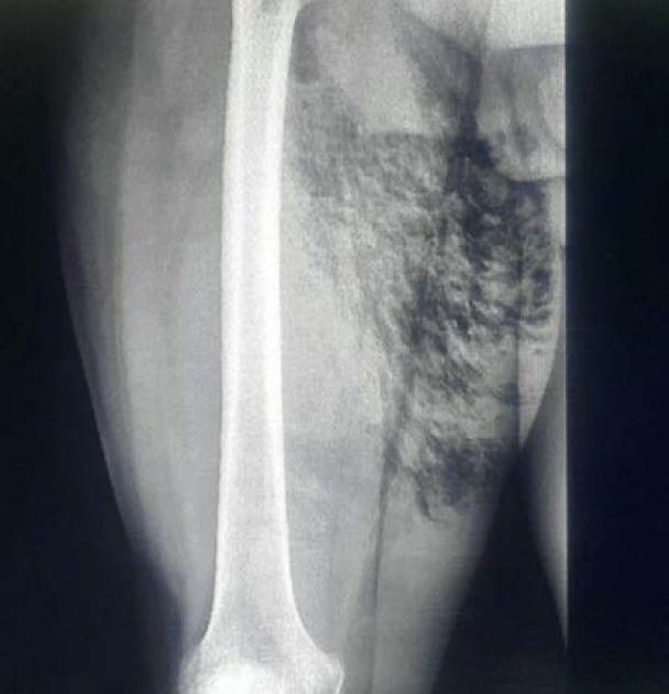 Necrotizing Fasciitis in a Patient with Diabetes Mellitus.