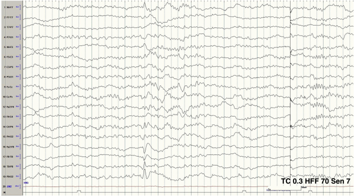 Post-operative nonketotic hyperglycemic induced focal motor status epilepticus related to treatment with corticosteroids following standard anterior temporal lobectomy