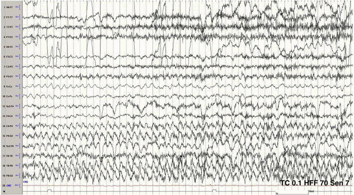 Post-operative nonketotic hyperglycemic induced focal motor status epilepticus related to treatment with corticosteroids following standard anterior temporal lobectomy