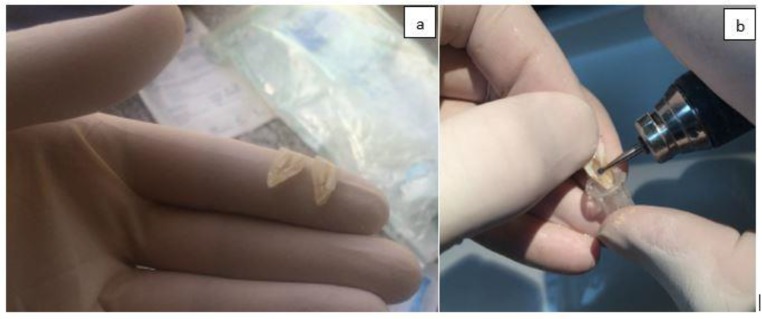 Minimum Intracanal Dressing Time of Triple Antibiotic Paste to Eliminate Enterococcus Faecalis (ATCC 29212) and Determination of Minimum Inhibitory Concentration and Minimum Bactericidal Concentration: An Ex Vivo Study.