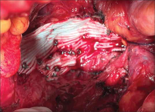 An Alternative Technique in the Control of Massive Presacral Rectal Bleeding: Fixation of GORE-TEX<sup>®</sup> Aortic Patch.
