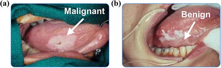 Current Practice and Emerging Molecular Imaging Technologies in Oral Cancer Screening.