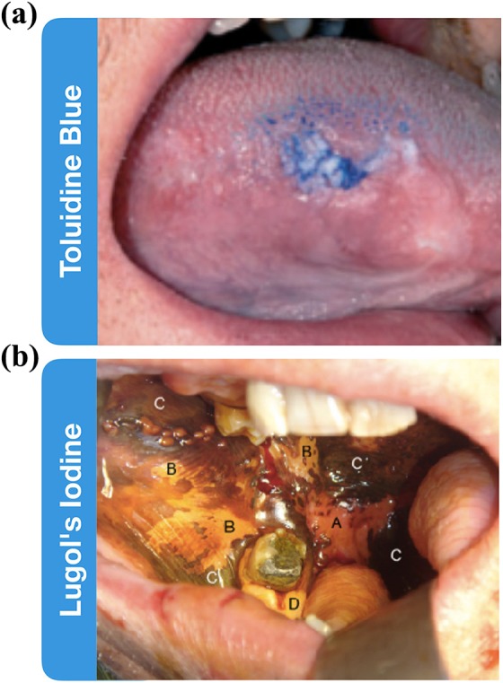 Current Practice and Emerging Molecular Imaging Technologies in Oral Cancer Screening.