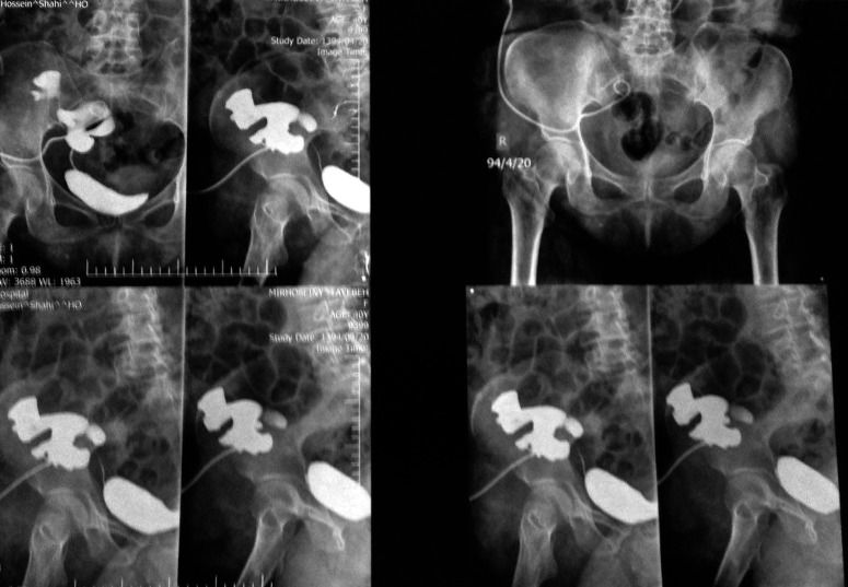 Post-transplantation Presentation of ANCA-associated Vasculitis: Granulomatosis with Polyangitis.