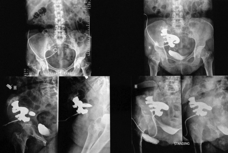 Post-transplantation Presentation of ANCA-associated Vasculitis: Granulomatosis with Polyangitis.