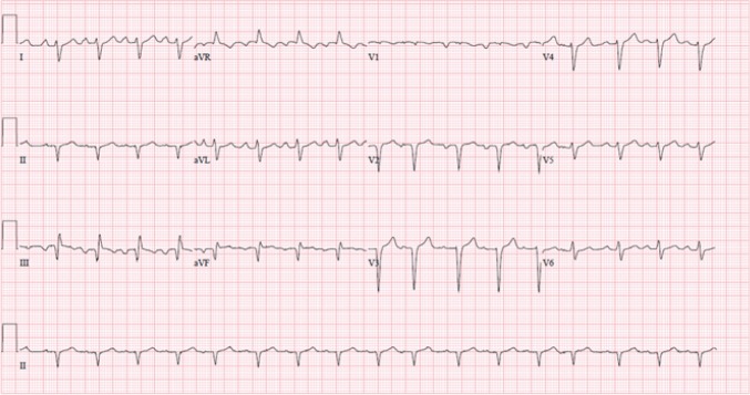 Methamphetamine-Induced Cardiomyopathy (MACM) in a Middle-Aged Man; a Case Report.