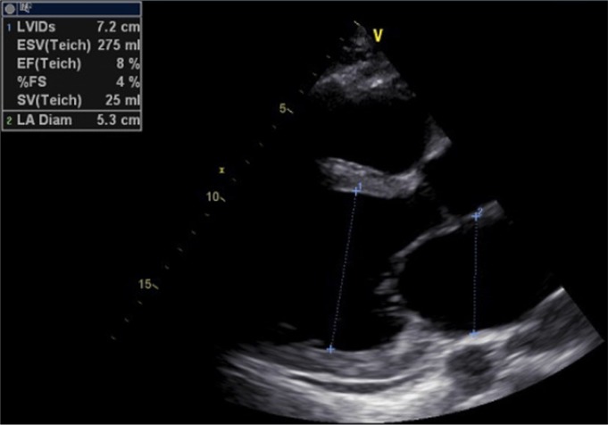 Methamphetamine-Induced Cardiomyopathy (MACM) in a Middle-Aged Man; a Case Report.