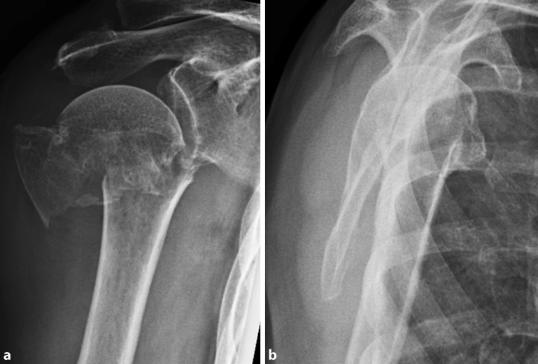 Cement augmentation of humeral head screws reduces early implant-related complications after locked plating of proximal humeral fractures.