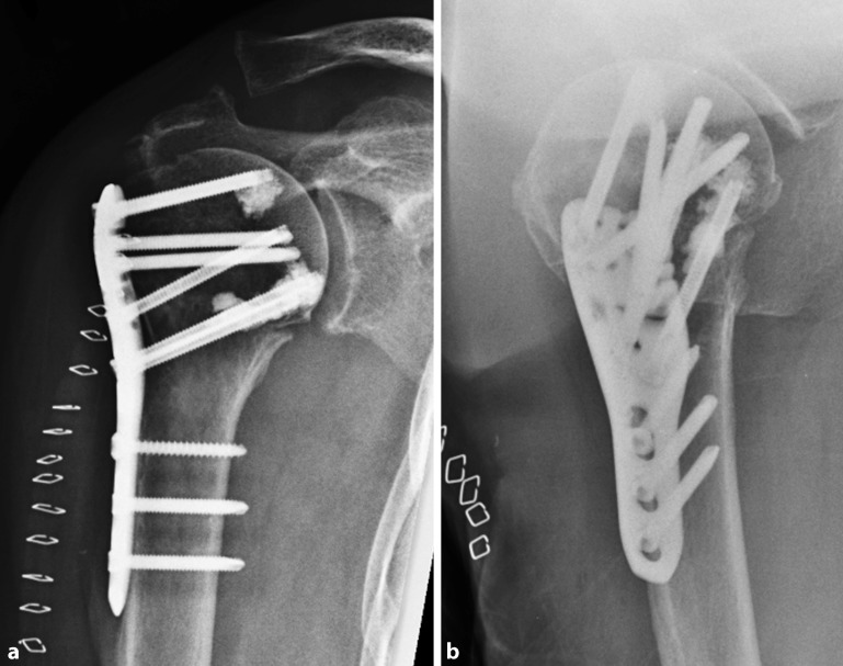 Cement augmentation of humeral head screws reduces early implant-related complications after locked plating of proximal humeral fractures.
