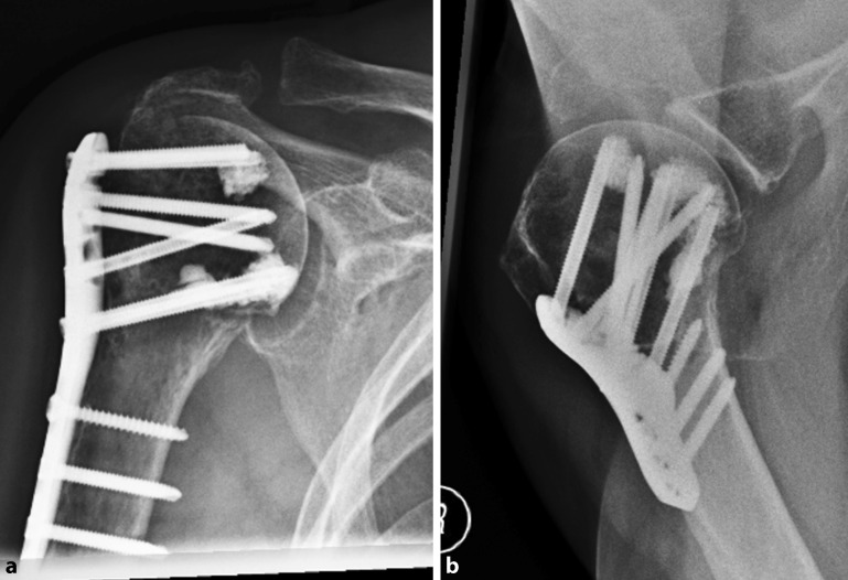 Cement augmentation of humeral head screws reduces early implant-related complications after locked plating of proximal humeral fractures.