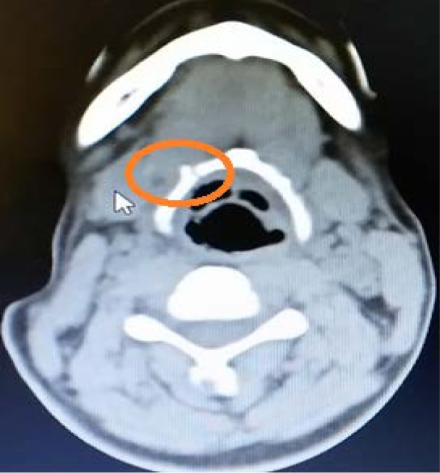 Blunt, Penetrating and Strangulating; Suicidal, Homicidal, Accidental and Sport-Related Neck Injuries: a Case Series and Literature Review.