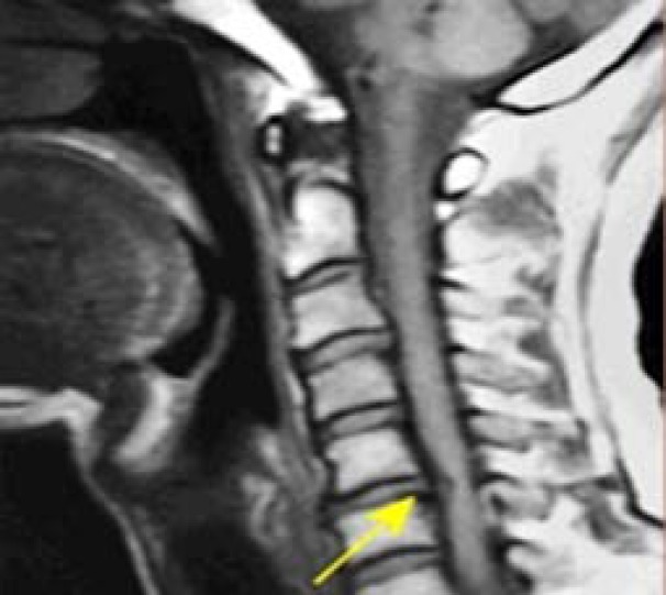 Blunt, Penetrating and Strangulating; Suicidal, Homicidal, Accidental and Sport-Related Neck Injuries: a Case Series and Literature Review.