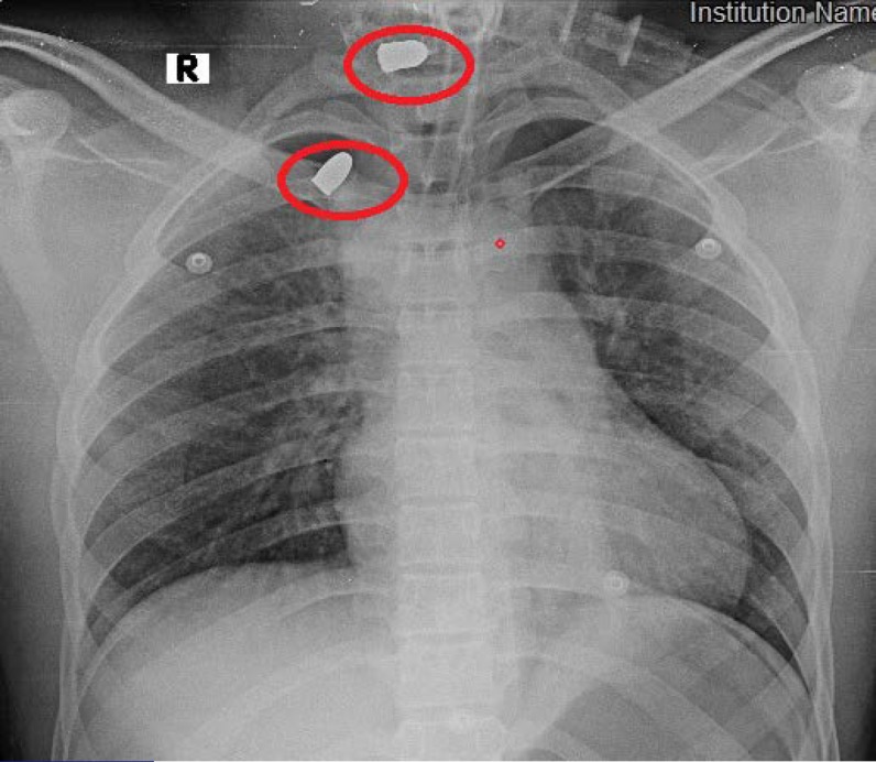 Blunt, Penetrating and Strangulating; Suicidal, Homicidal, Accidental and Sport-Related Neck Injuries: a Case Series and Literature Review.