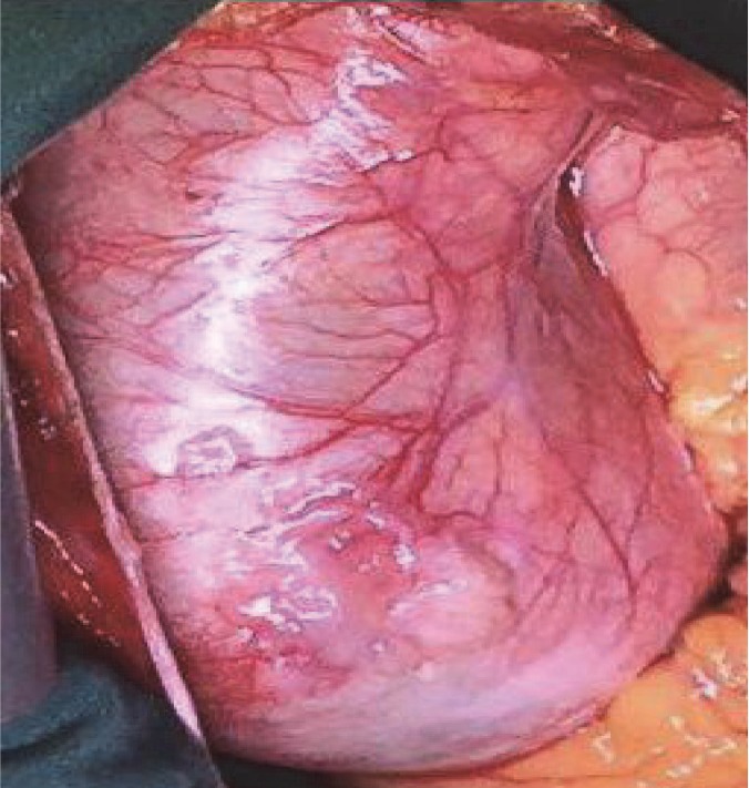 Combined Aortic Root Replacement and Heart Transplantation in a Patient with Dilated Cardiomyopathy and Aortic Root Aneurysm.