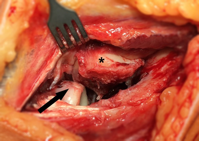 Fractures of the capitellum humeri and their associated injuries.