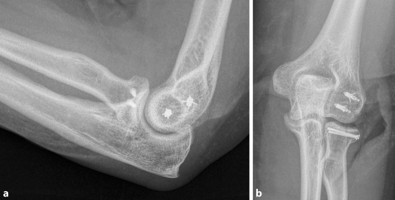 Fractures of the capitellum humeri and their associated injuries.