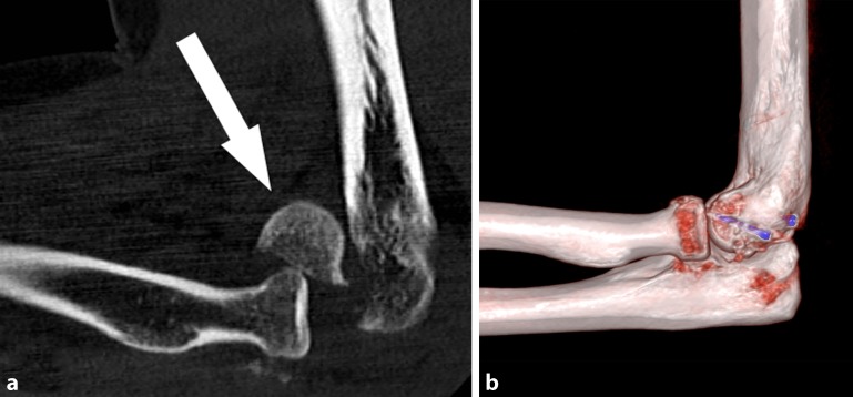 Fractures of the capitellum humeri and their associated injuries.