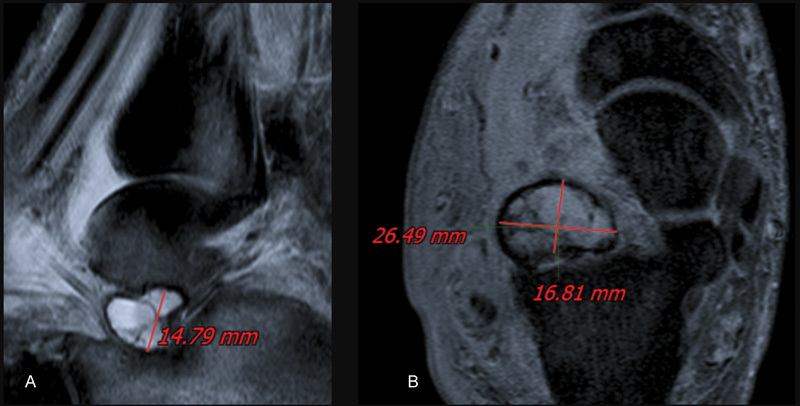 Giant Cells Osseous Tumor in the Tarsal Canal after Lateral Ankle Sprain.