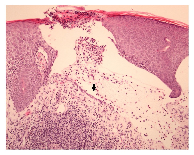 Immune Toxicity with Checkpoint Inhibition for Metastatic Melanoma: Case Series and Clinical Management.