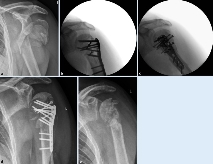 Rate of avascular necrosis after fracture dislocations of the proximal humerus: Timing of surgery.