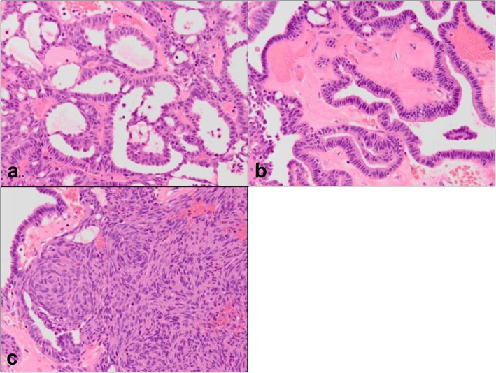 Biphasic low-grade nasopharyngeal papillary adenocarcinoma: a case report and literature review.