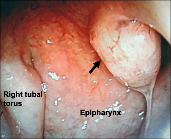 Biphasic low-grade nasopharyngeal papillary adenocarcinoma: a case report and literature review.