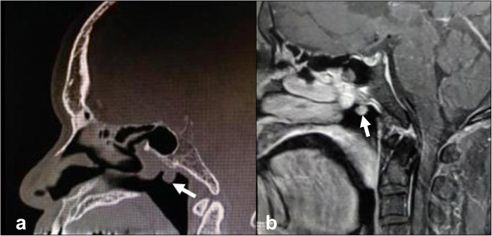 Biphasic low-grade nasopharyngeal papillary adenocarcinoma: a case report and literature review.