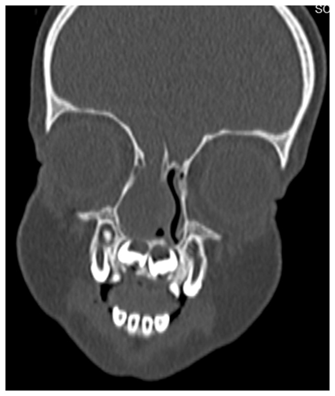 Pediatric Meningoencephaloceles Endoscopic Endonasal Repair: Our Experience.