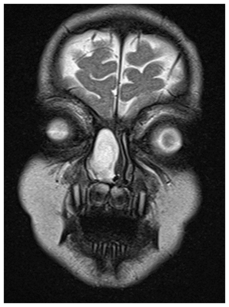 Pediatric Meningoencephaloceles Endoscopic Endonasal Repair: Our Experience.