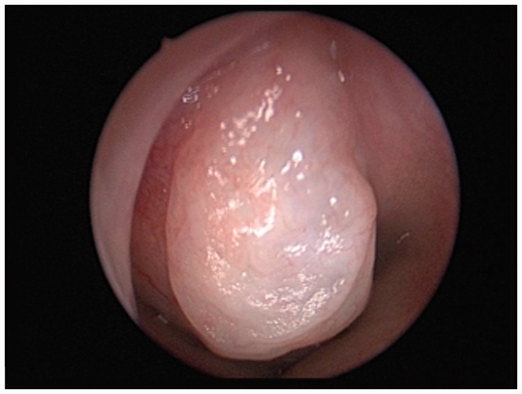 Pediatric Meningoencephaloceles Endoscopic Endonasal Repair: Our Experience.