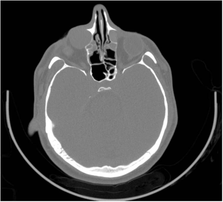 Endoscopic Management of Lacrimal System Dysgenesis and Dacryocystoceles in Fraser Syndrome: A Case Report and Literature Review.