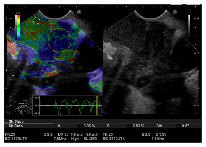 Endoscopic Ultrasound Elastography for Evaluation of Lymph Nodes: A Single Center Experience.