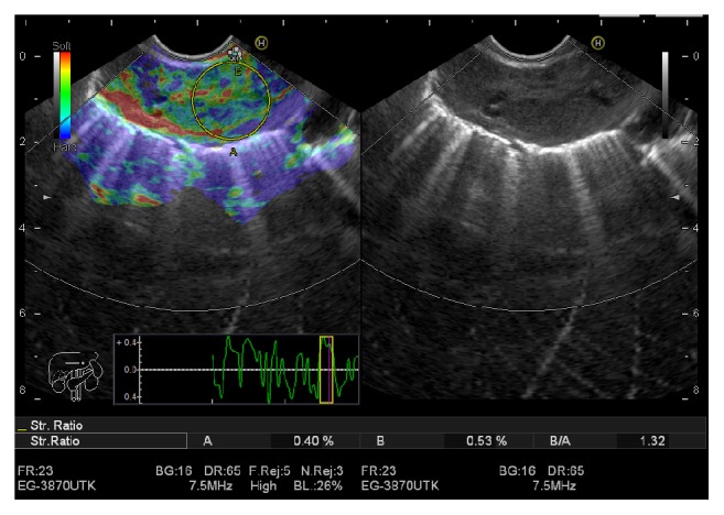 Endoscopic Ultrasound Elastography for Evaluation of Lymph Nodes: A Single Center Experience.