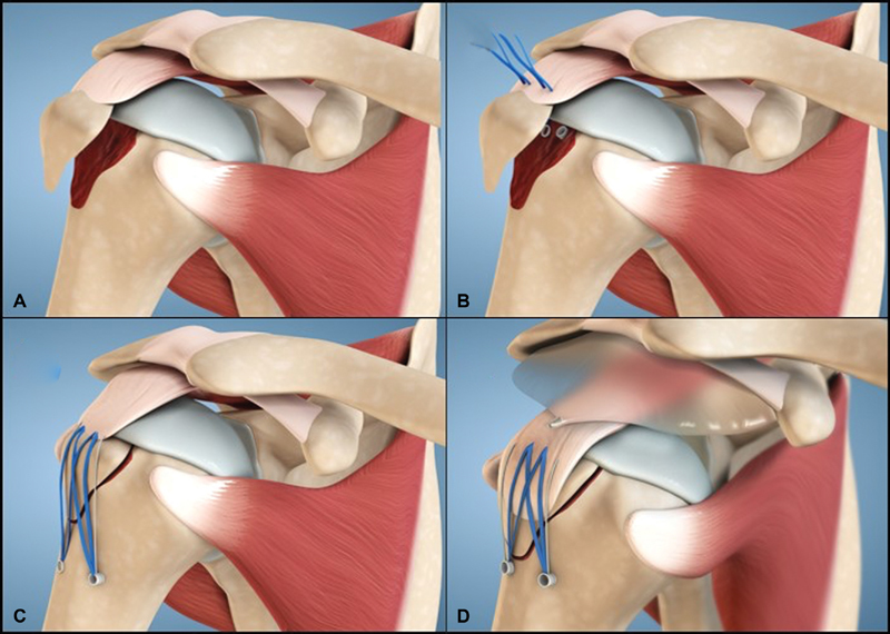 Surgical Management of Comminuted, Displaced Greater Tuberosity Fractures: A New Technique of Subacromial Spacer on Top of Double-Row Suture Anchor Fixation.