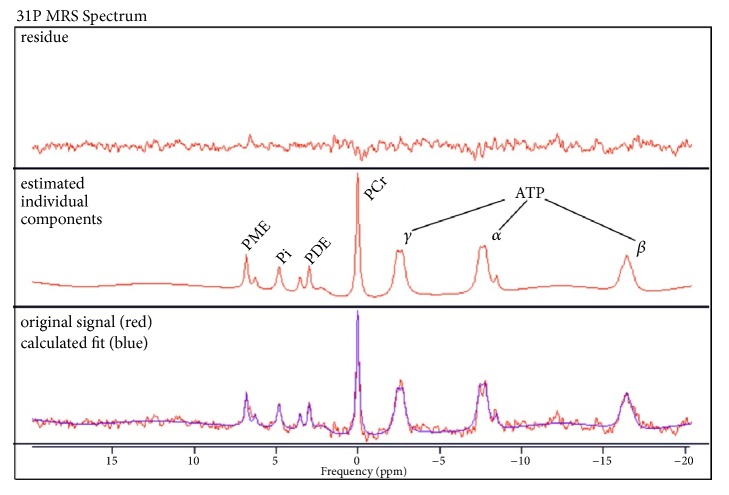 Cerebral Phosphorus Magnetic Resonance Spectroscopy in a Patient with Giant Cell Arteritis and Endovascular Therapy.