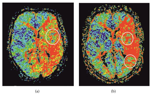 Cerebral Phosphorus Magnetic Resonance Spectroscopy in a Patient with Giant Cell Arteritis and Endovascular Therapy.