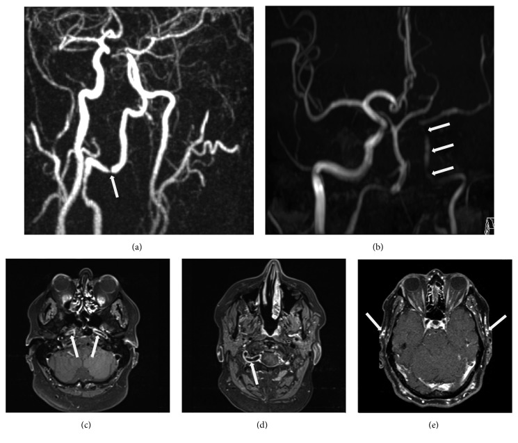 Cerebral Phosphorus Magnetic Resonance Spectroscopy in a Patient with Giant Cell Arteritis and Endovascular Therapy.