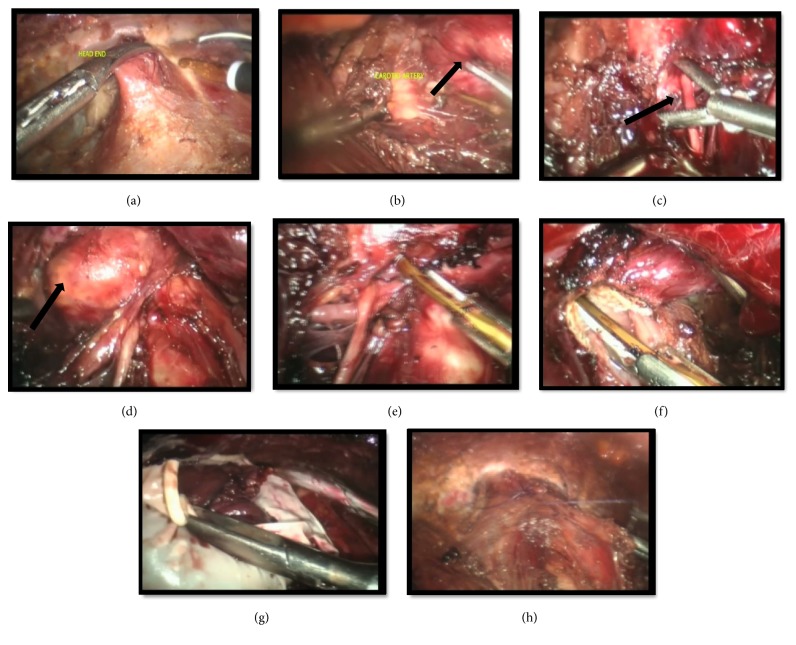 Feasibility of Endoscopic Thyroidectomy via Axilla and Breast Approaches for Larger Goiters: Widening the Horizons.